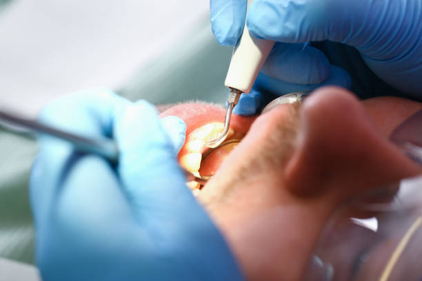 Best Emergency Dentist for Lost Fillings or Crowns in Zebulon, NC